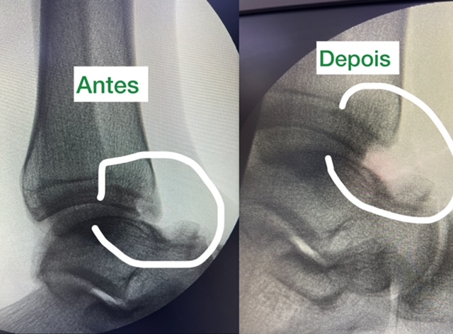 cirurgia de tornozelo para impacto anterior