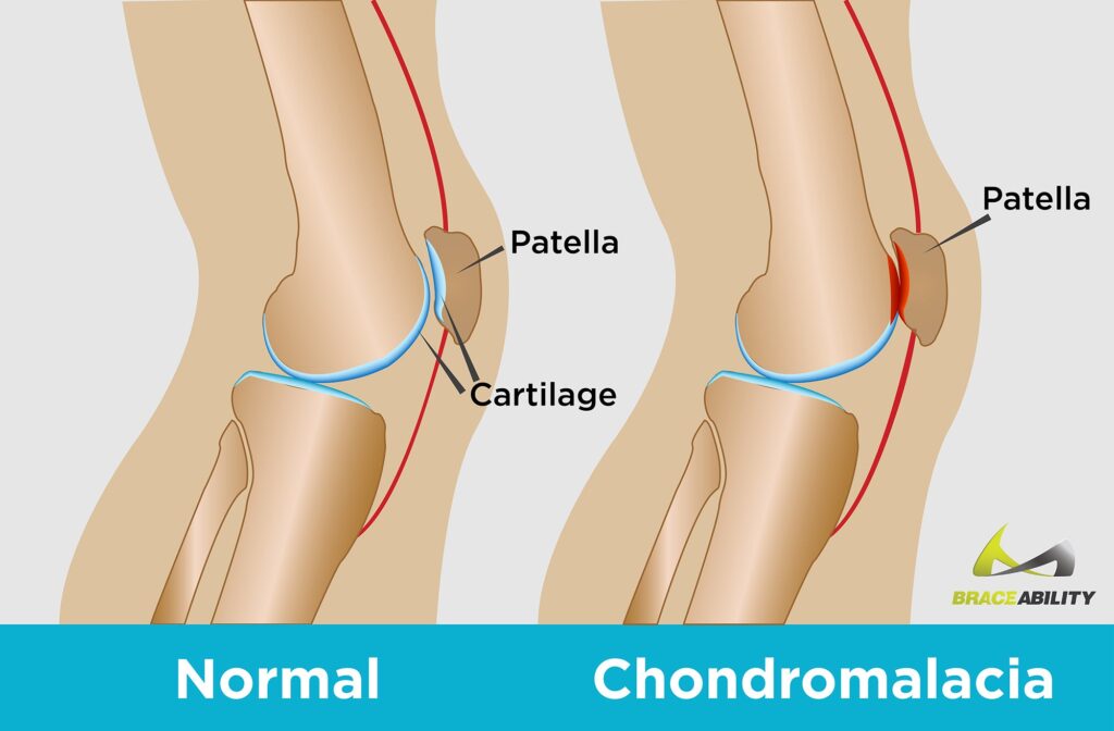 condropatia de patela - em azul a cartilagem normal e em vermelho vemos a região dos desgaste 