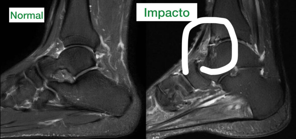 imagem de ressonância magnética mostrando o motivo da dor no tornozelo - esporão anterior