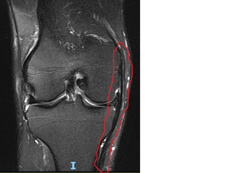 imagem de ressonância magnética - em vermelho vemos o ligamento colateral medial