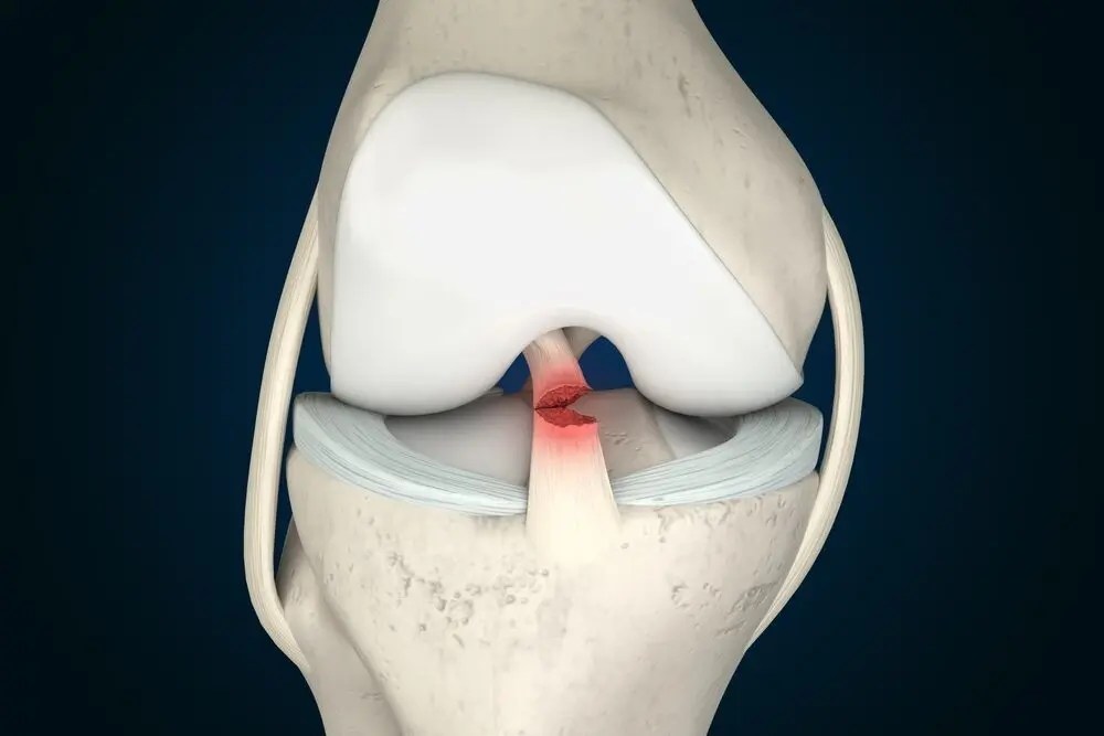 Anatomia do joelho evidenciando a lesão do ligamento cruzado anterior