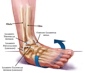 torção do tornozelo