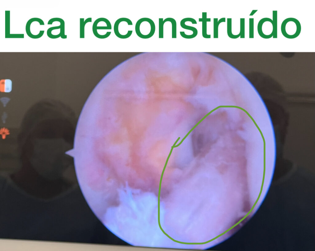 cirurgia lca joelho - em verde o "novo" lca