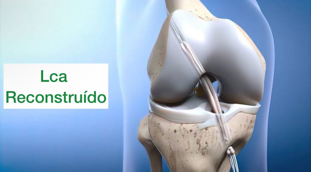 cirurgia LCA mostrado de forma didática, com o ligamento reconstruído