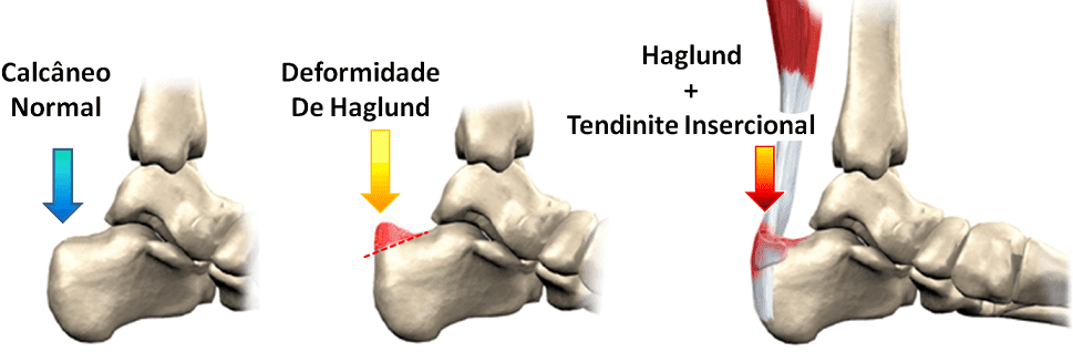 sindrome de haglund, primeira imagem o calcâneo normal, na segunda deformidade de Haglund, na terceira mostrando tendinite do tendão calcâneo.