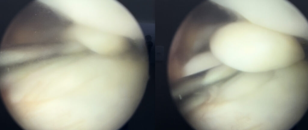 artroscopia de menisco mostrando a instabilidade meniscal 