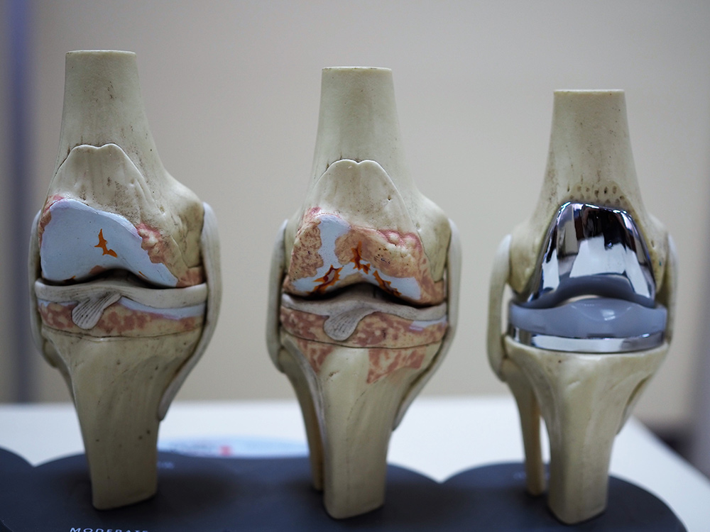 3 peças mostrando desgaste da cartilagem do joelho em uma fase mais inicial, depois mais avançada e por ultimo com protese total