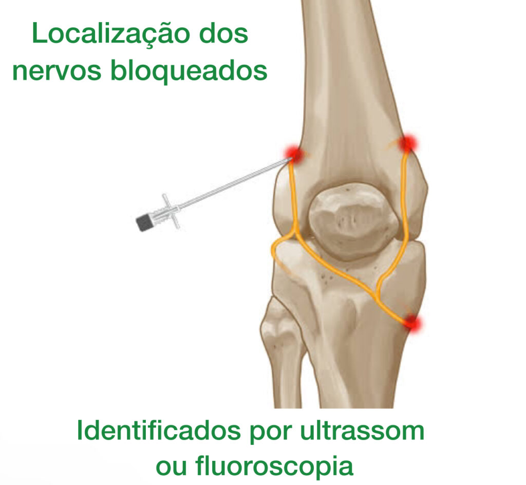 bloqueio de nervo no joelho, mostrando os 3 nervos que serão anestesiados
