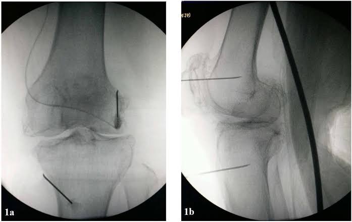 bloqueio dos nervos geniculares no joelho, imagem da fluoroscopia para identificar os nervos