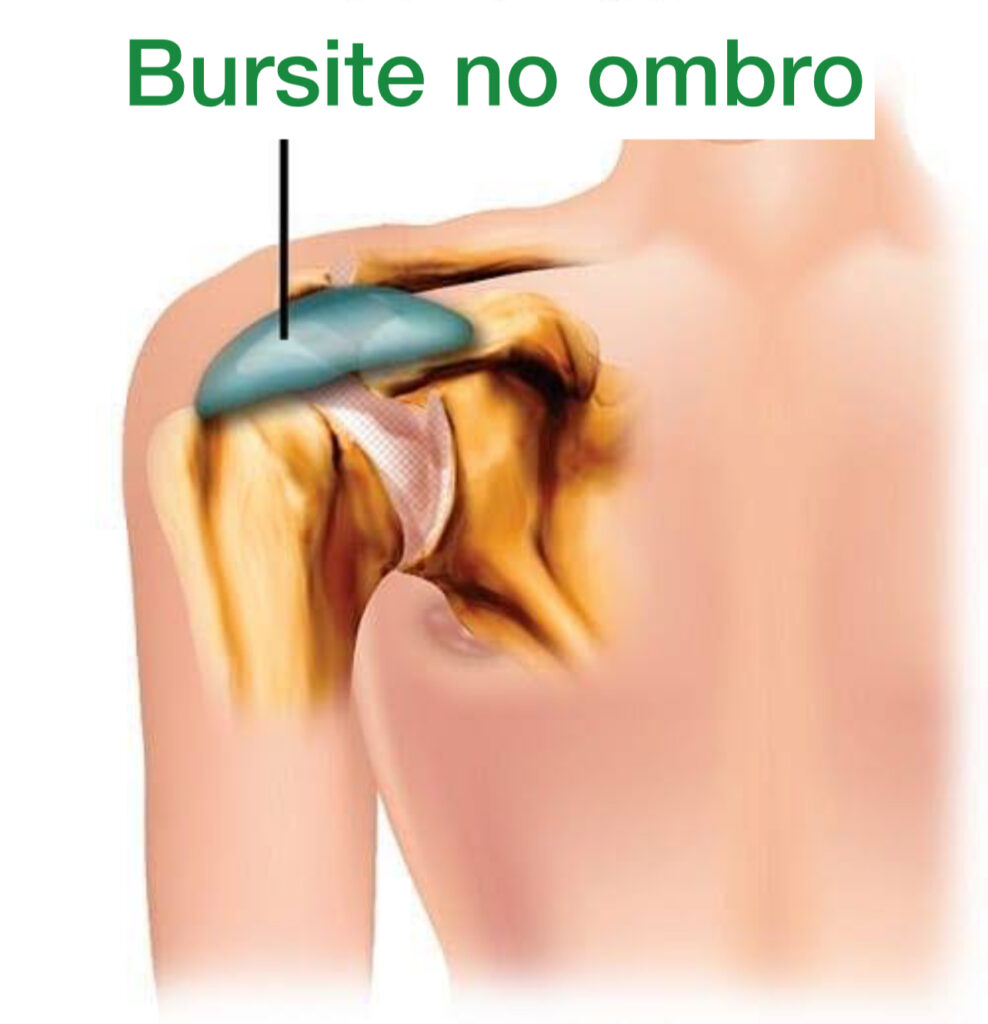 em azul vemos a inflamação da bursa no ombro