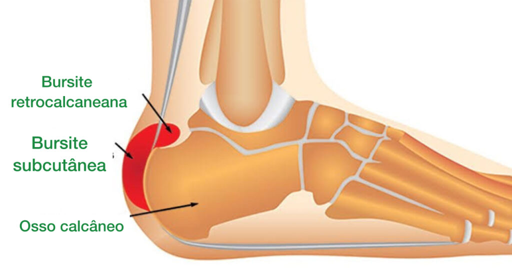 bursites no pe - dor na região posterior do calcanhar