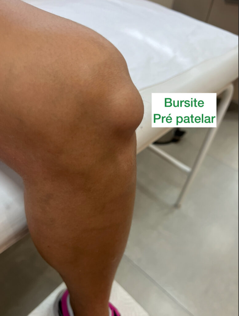 bursite pré patelar 