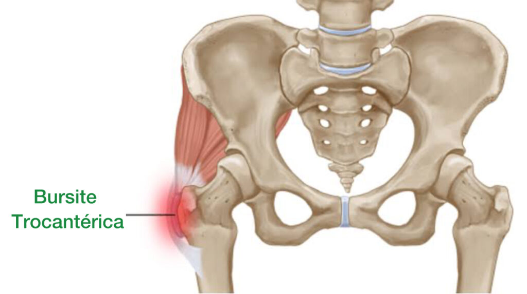 em vermelho o local da dor na bursite trocanterica
