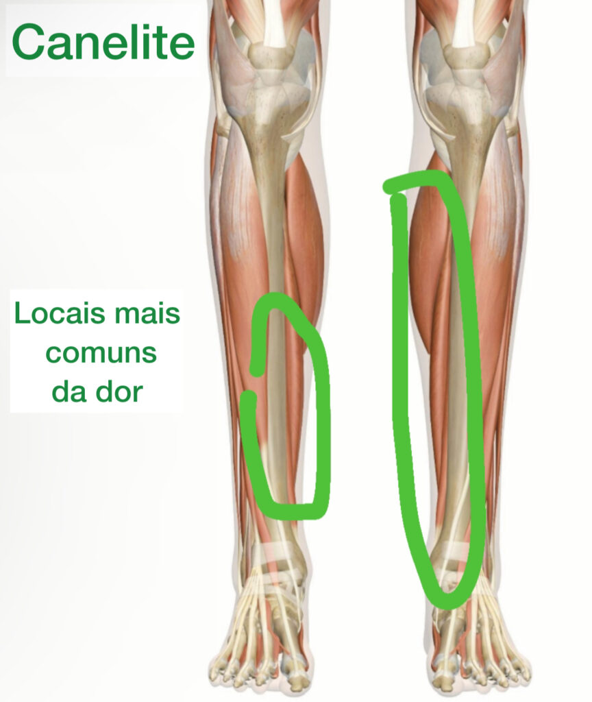 canelite, em verde mostra os locais mais comuns de dor