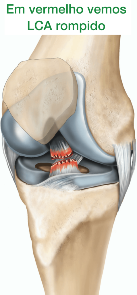 cirurgia LCA - em vermelho o ligamento rompido