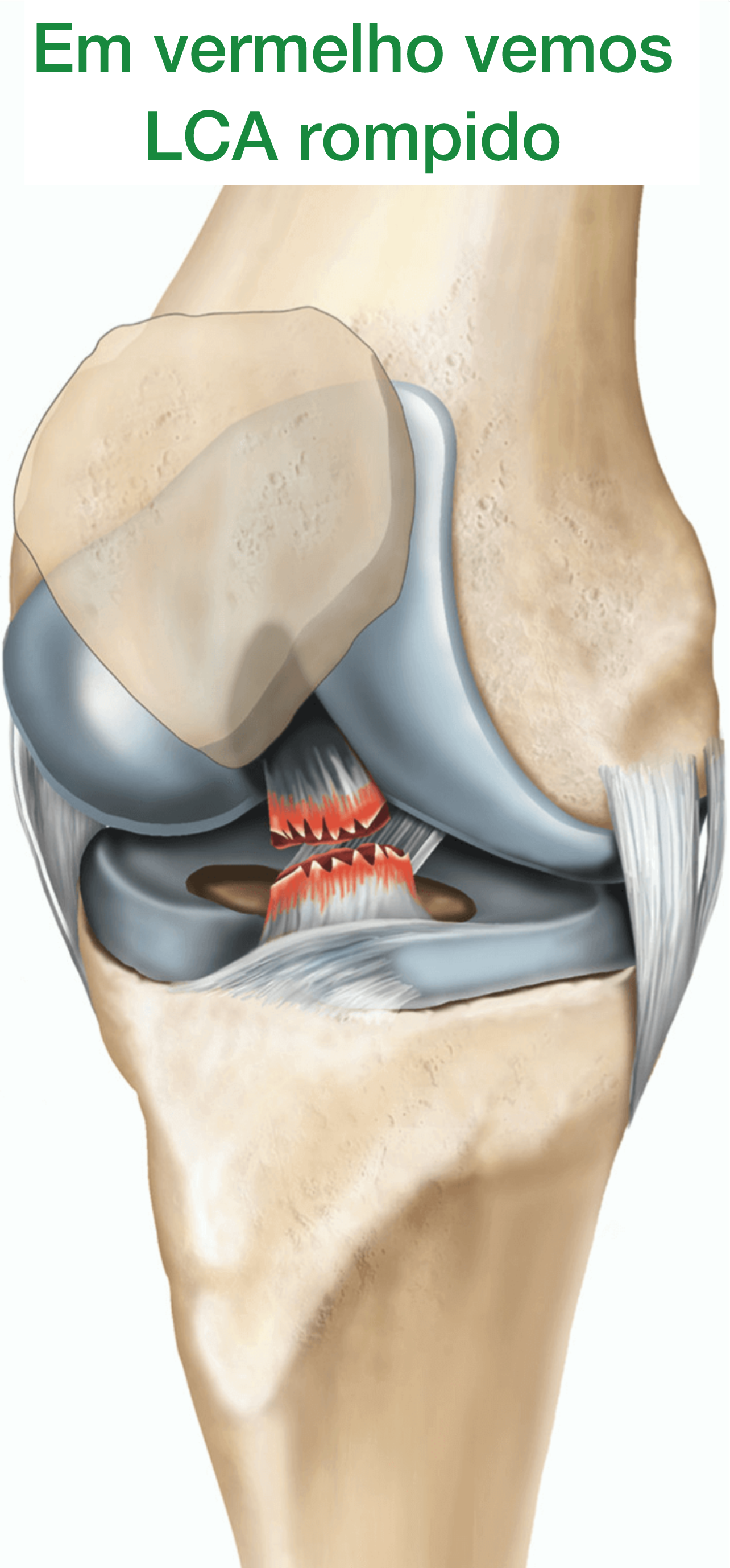 Cirurgia LCA - Ligamento Cruzado Anterior - Dr. Thiago Protta