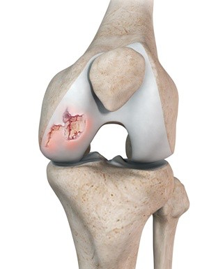 femoropatelar, dor relacionada a lesão da cartilagem