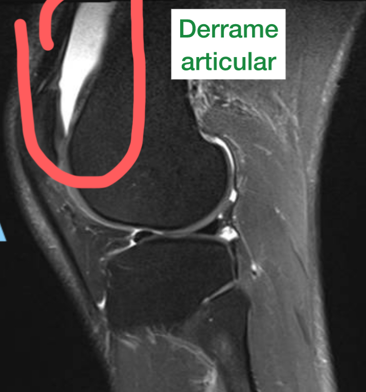 imagem de ressonância mostrando em branco o derrame articular (água no joelho)
