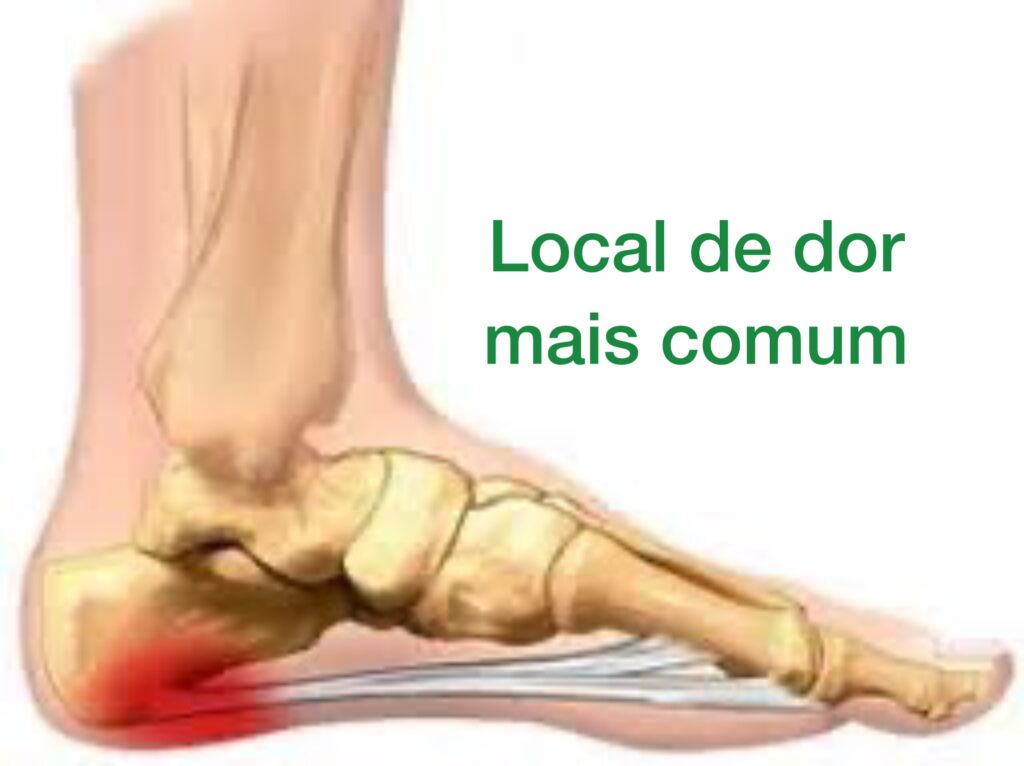 local mais comum de dor na fascite plantar