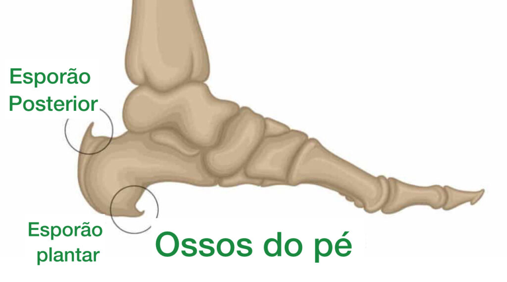 esporão de calcaneo indicado na região plantar e posterior do pé