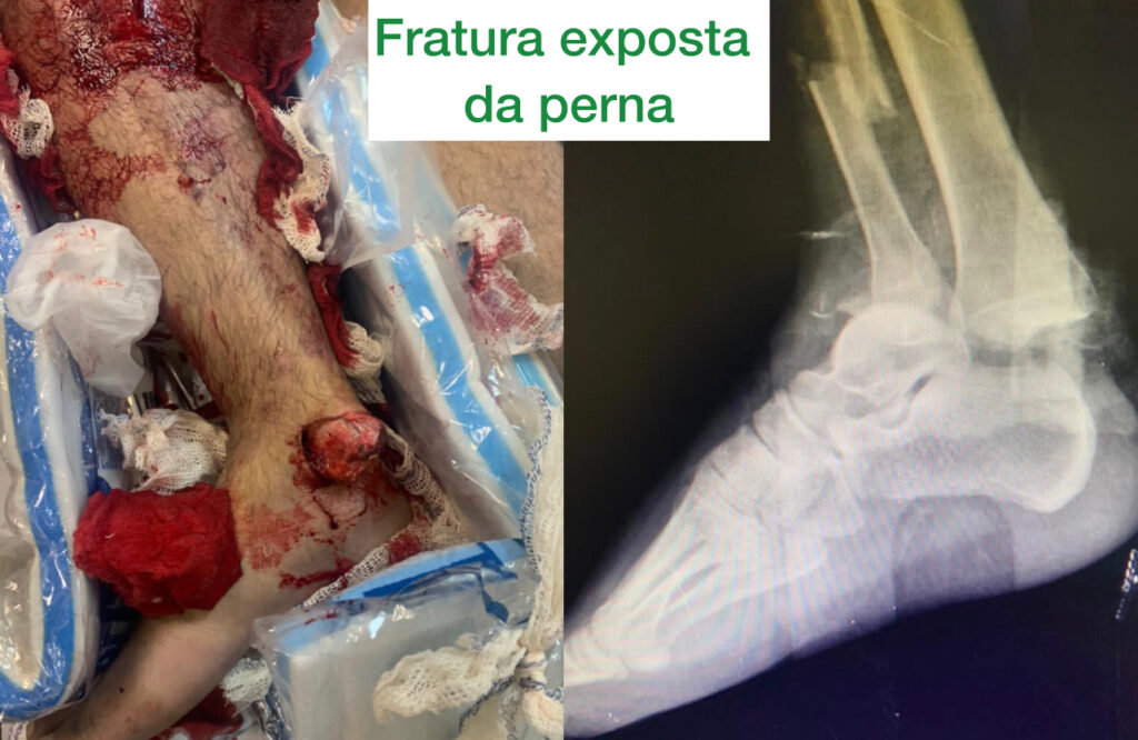 fratura exposta de tibia: primeira imagem vemos a foto da perna com osso exposto, na segunda a radiografia