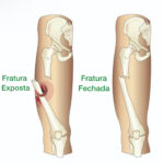 Fratura Exposta: Entendendo as Fraturas Expostas de Fêmur e Tíbia
