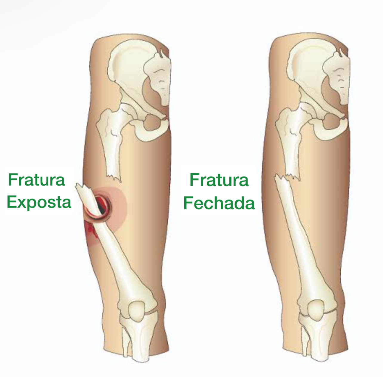 fratura exposta de femur