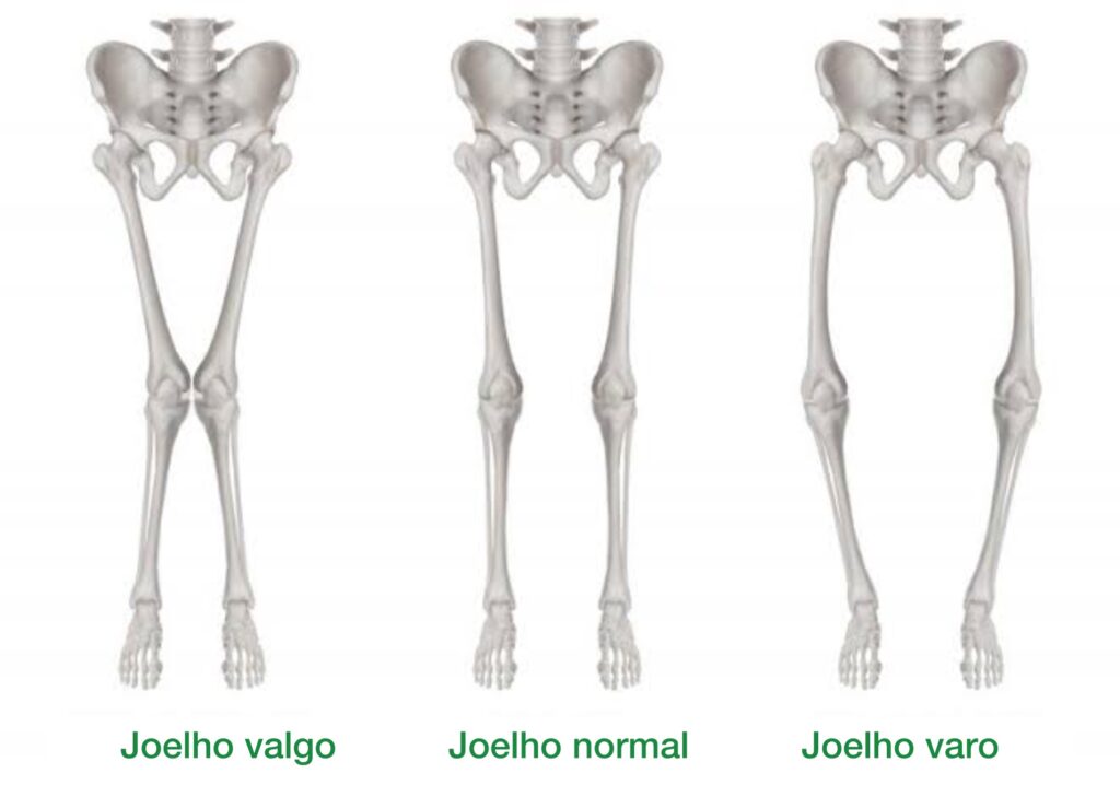 joelho varo ao lado do joelho normal e joelho valgo