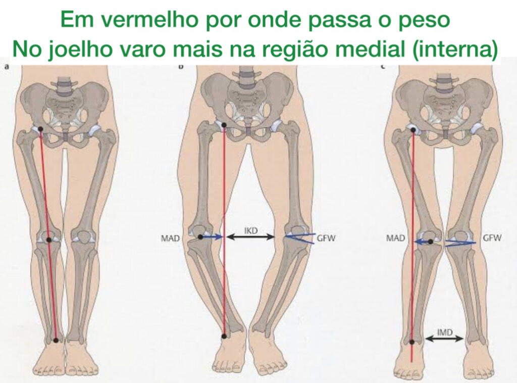 no joelho varo vemos que o peso passa na região mais interna dos joelhos (medial)