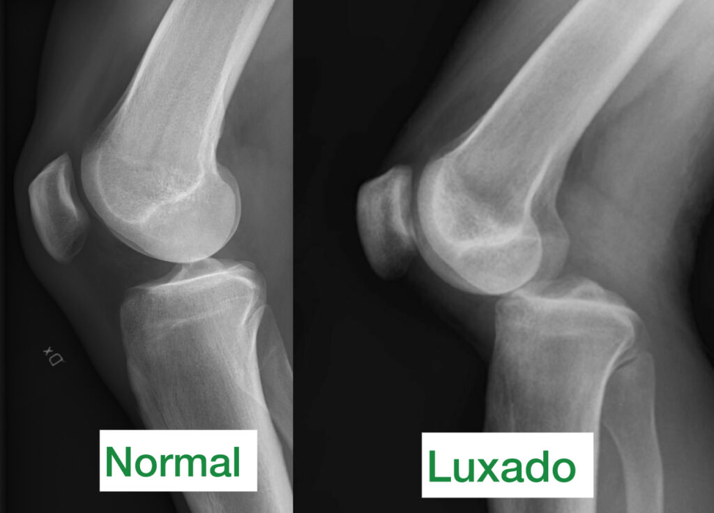 luxação no joelho, radiografia mostrando bom alinhamento do osso e o segundo raio x mostrando a luxação 