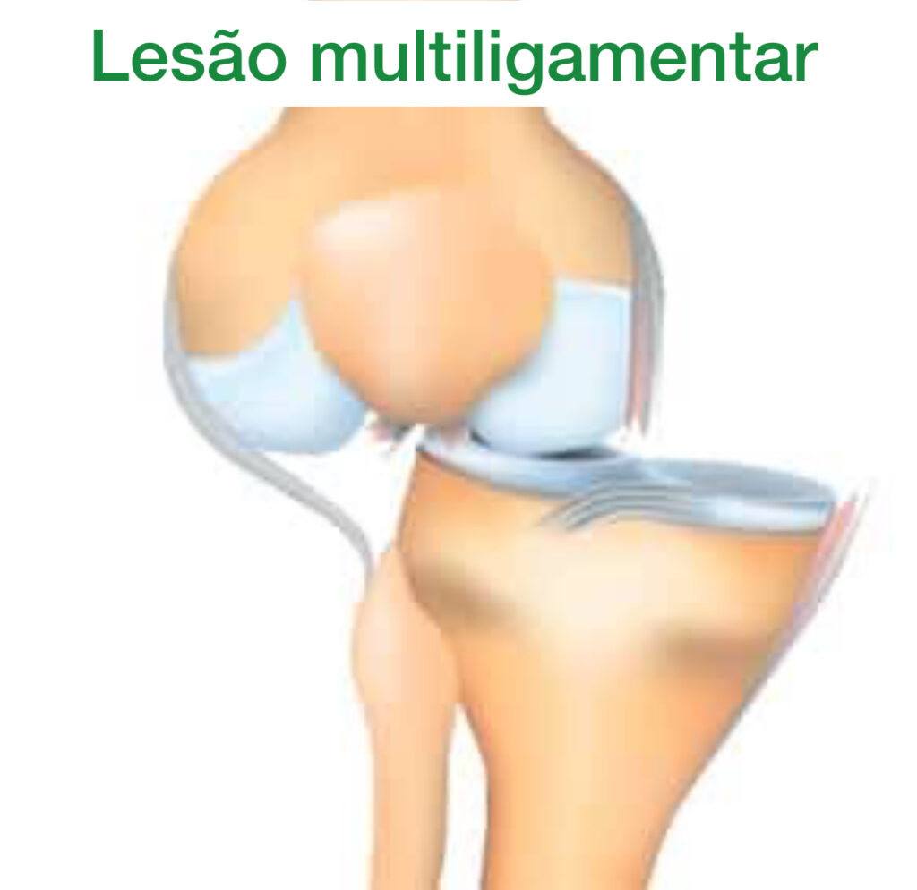 luxação no joelho mostrando múltiplos ligamentos lesionados