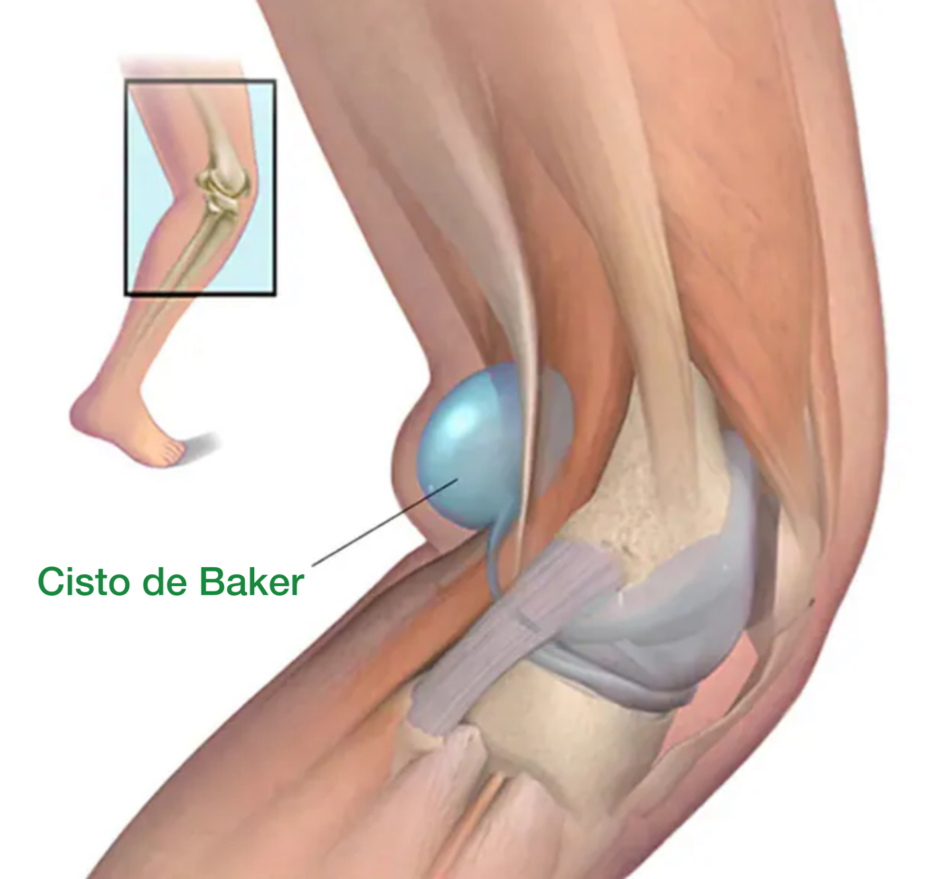 cisto da baker na região posterior do joelho