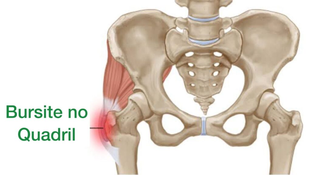 anatomia da bursite no quadril