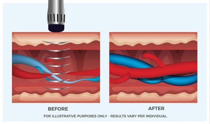 tratamento para bursite no quadril - terapia por ondas de choque