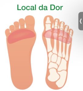 metataralgia - local de dor