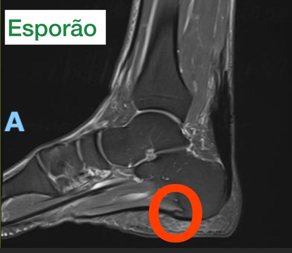 imagem de ressonância magnetica mostrando o que é esporão na região plantar do osso do calcâneo