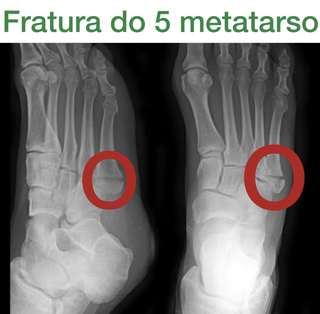 fratura do 5 metatarso - anatomia dos ossos do pé