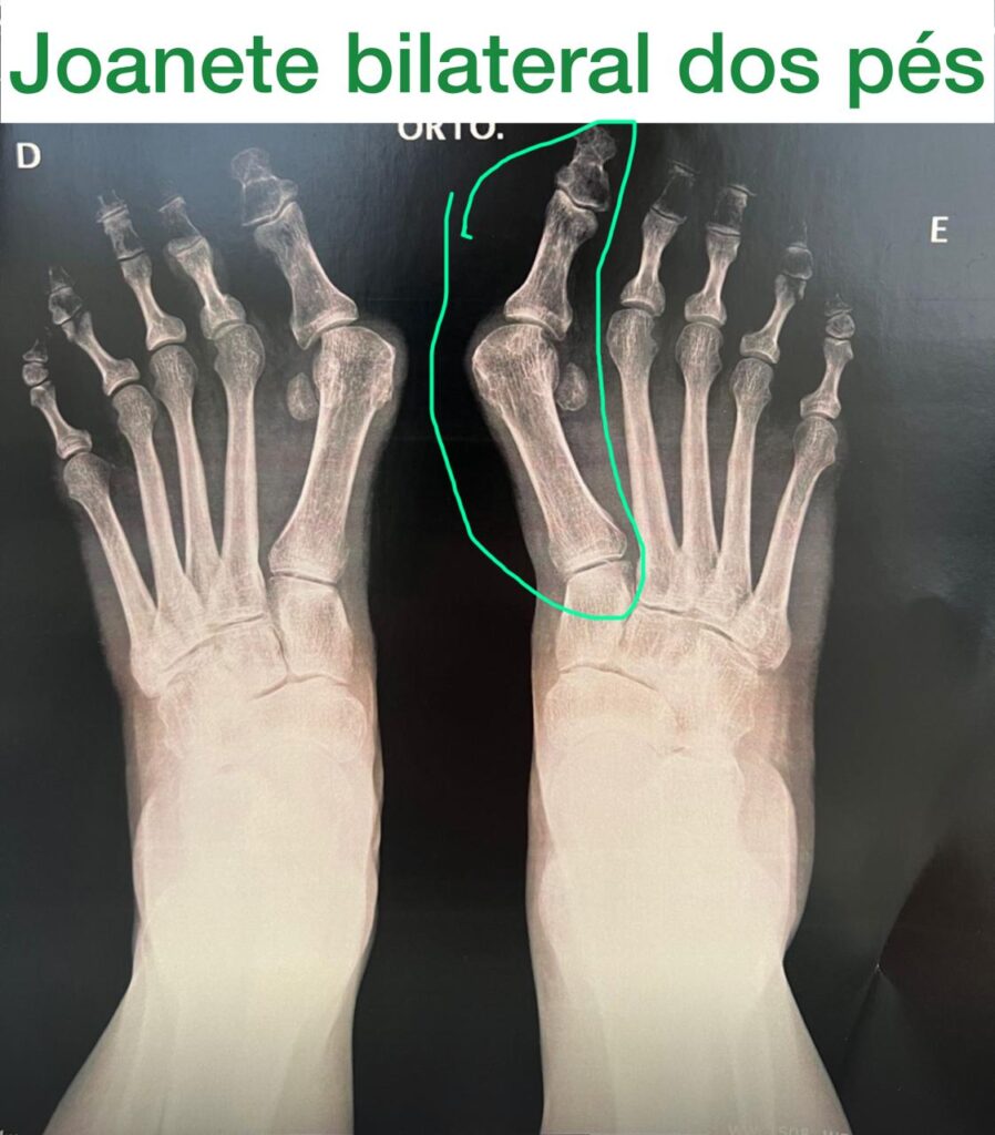 ossos do pé podendo ser observado joanete bilateral 