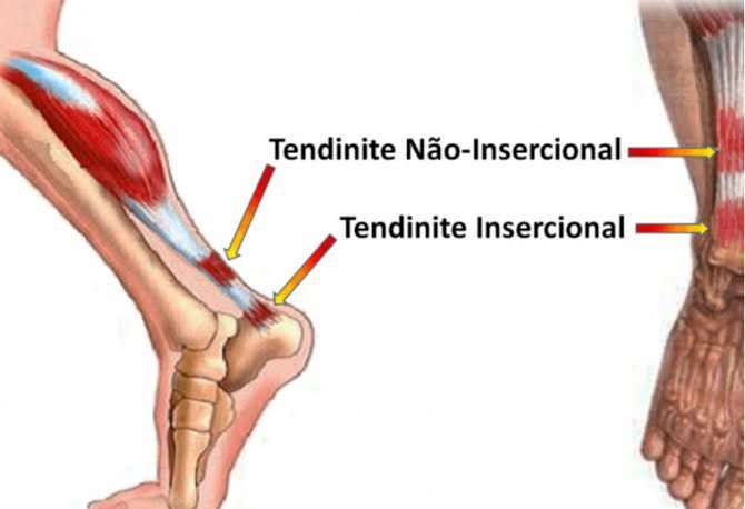 tendão de Aquiles: tendinite insercional e não insercional