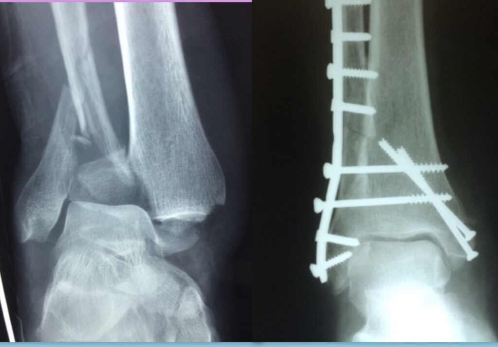 tornozelo inchado fraturado - imagem de rx da fratura e após a cirurgia