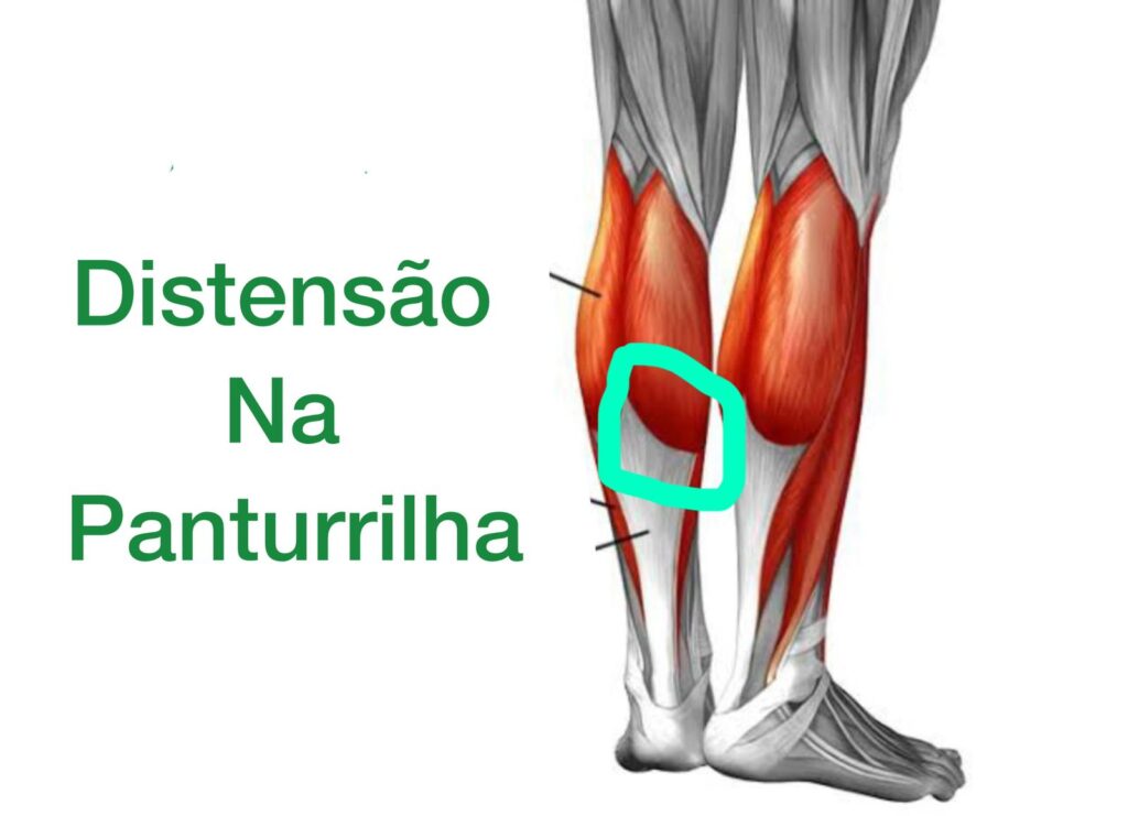 local mais comum da distensão na panturrilha marcada com um circulo (músculo gastrocnêmio medial)