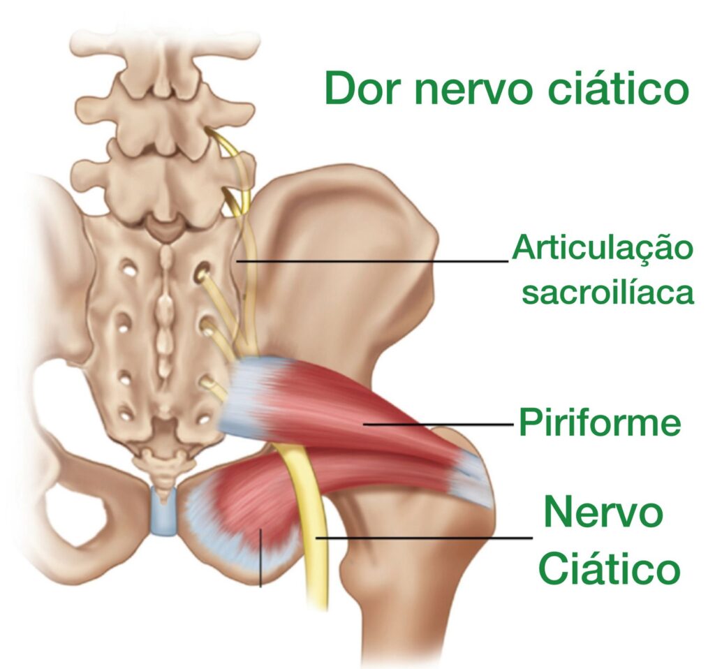 ciatalgia devido a sindrome do piriforme