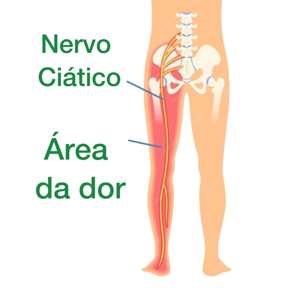 nervo ciático e o local da região que fica dolorosa quando esta inflamado