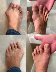 joanete antes e depois