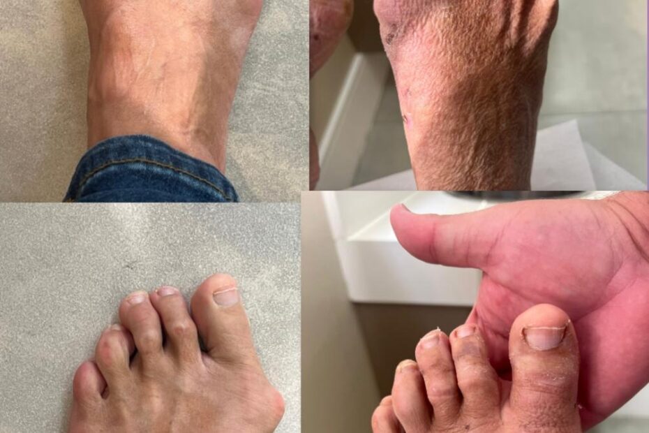 joanete antes e depois