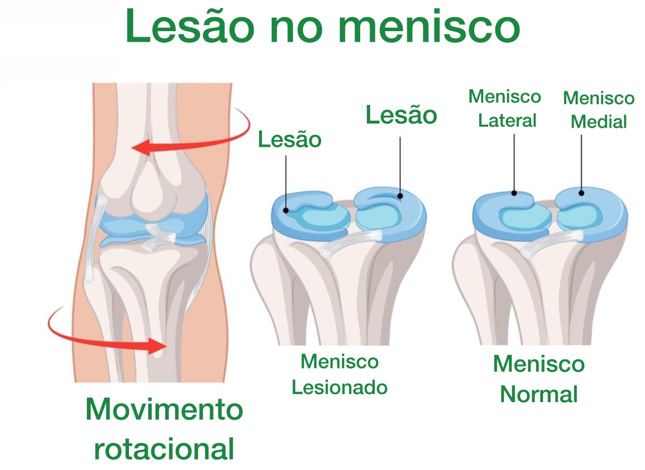 Dor no Joelho: as 15 principais causas - Dr. Thiago Protta