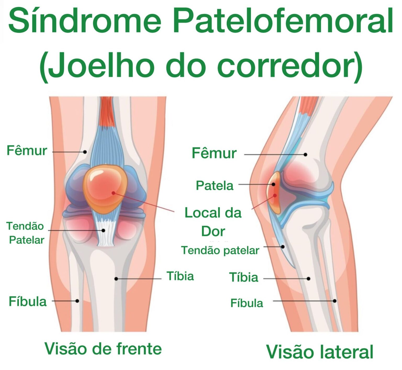 Dor no Joelho: as 15 principais causas - Dr. Thiago Protta