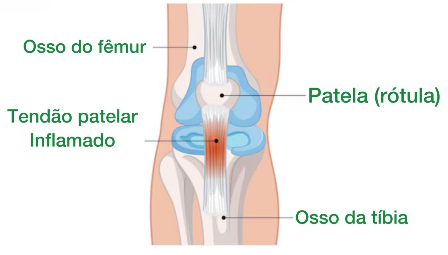 Dor no Joelho: as 15 principais causas - Dr. Thiago Protta