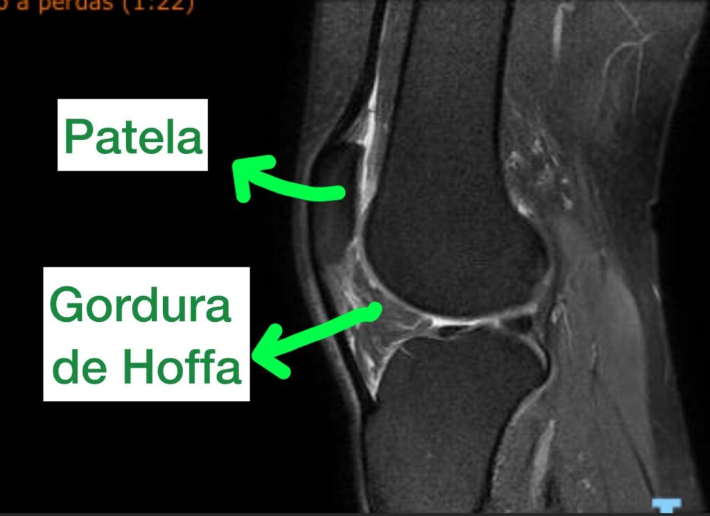 imagem de ressonância magnetica mostrando hoffite