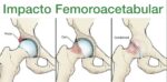 Pubalgia: Causas, Sintomas e Tratamentos - Dr. Thiago Protta